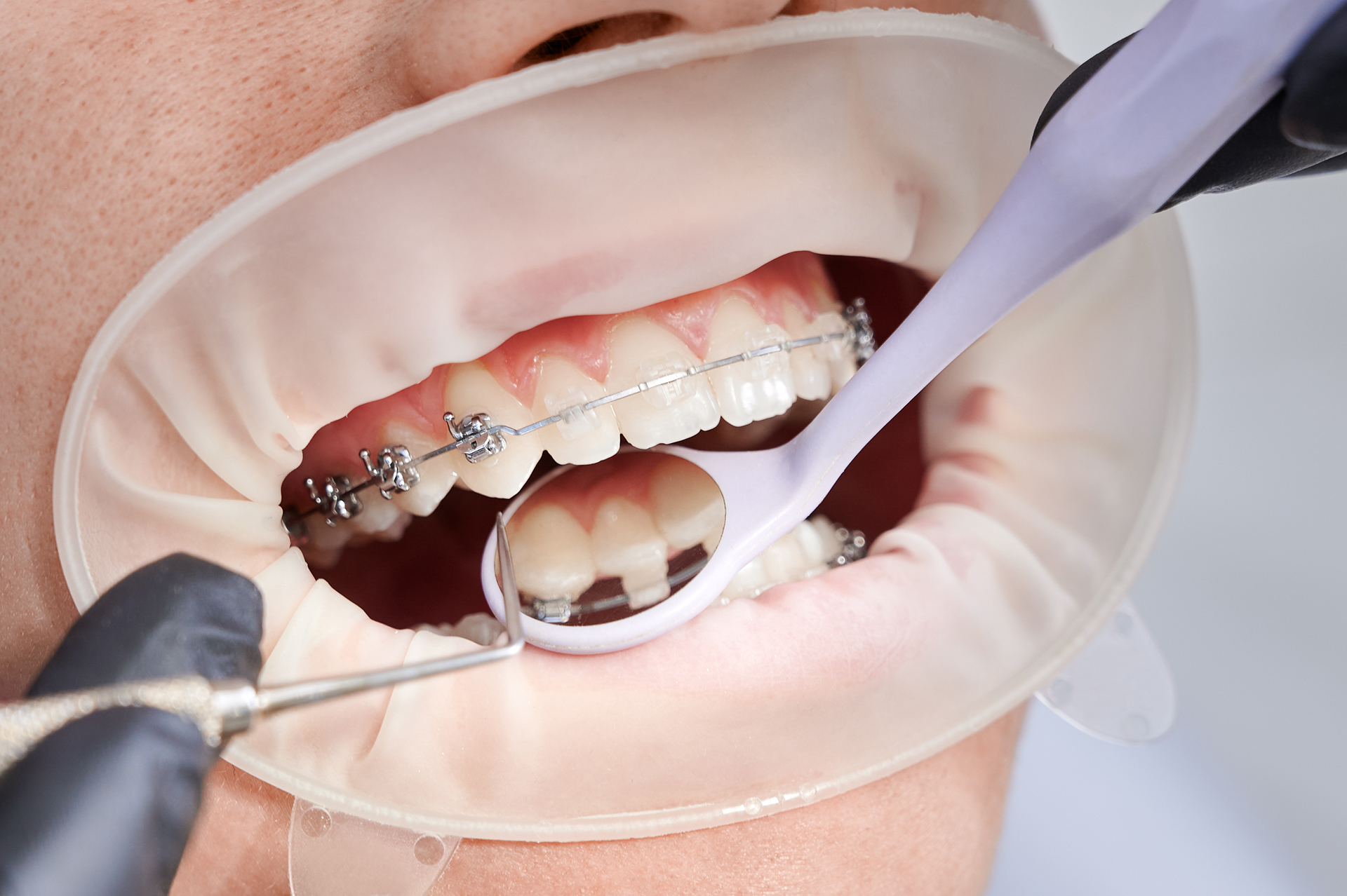 Schöne Zähne durch Zahnkorrektur